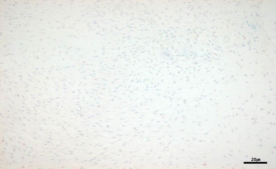 (D) Negative for S-100 stain, 200, Scale bar, 20 μm. Figure 3.