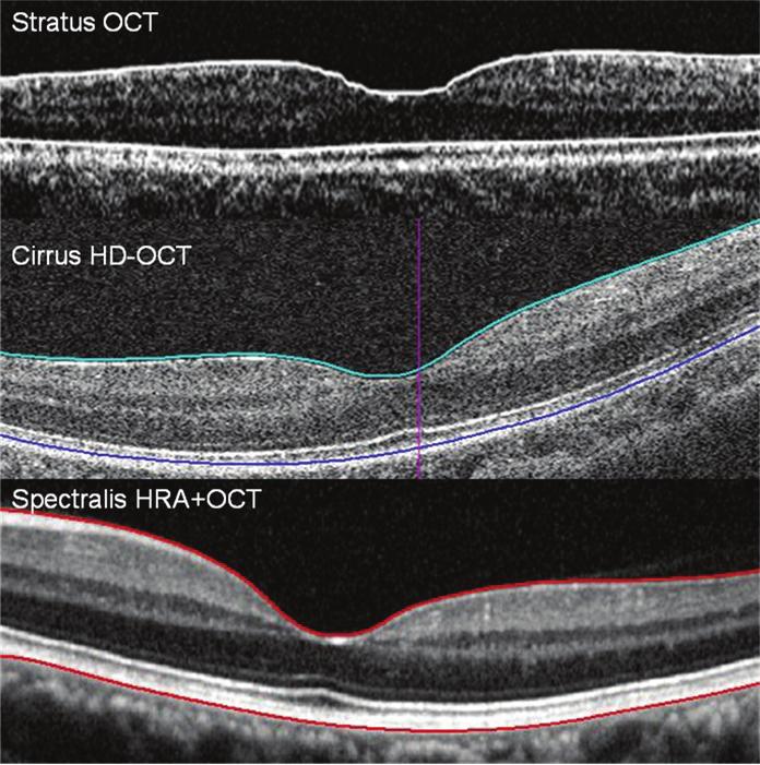 - 문성운외 : 빛간섭단층촬영의측정치와재현성 - Figure 6. Tomographies of the macula taken by the three OCTs with reference lines.