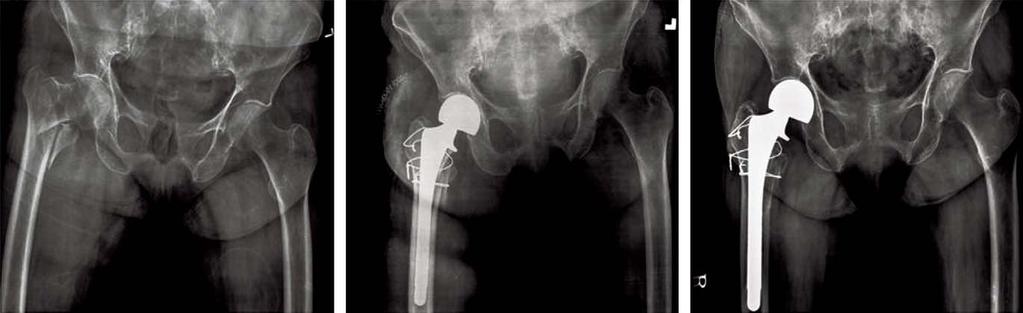 Chae-Hyun Lim et al.: Hemiarthroplasty for Hip Fractures in Elderly Patients over 80 Years Old 고관절골절이전체고관절골절의 24% 를차지하였다.