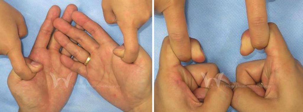 After 14 months, when he visited, he could flex the recovered power of thumb interphalangeal joint and index distal interphalangeal joint flexion. 능의회복을빠르게하지도않았다.