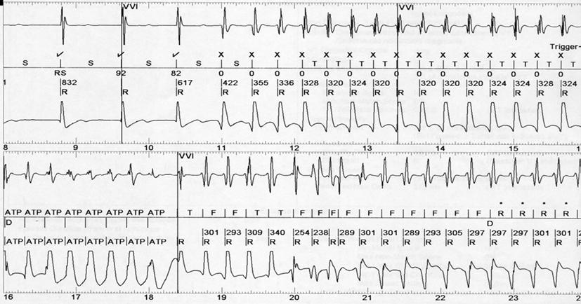 Jong Wook Kim, et al. 579 Fig. 4. An example of overdrive acceleration in patient number 1. An example of overdrive acceleration is shown.