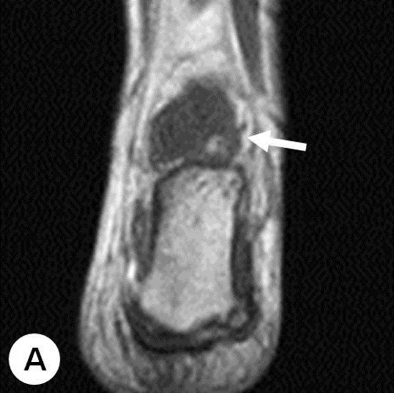 채종우 외. 청소년 야구 선수에서 발생한 거골하 관절의 활액막 골연골종증 Fig. 3. Magnetic resonance imaging of the left ankle. (A) The T1-weighted coronal image demonstrated a lobulated low signal intensity mass (arrow).
