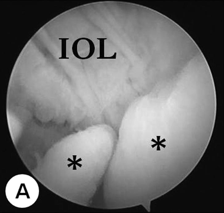 JW Chae, et al. Synovial Osteochondromatosis of the Subtalar Joint in an Adolescent Baseball Player Fig. 4.