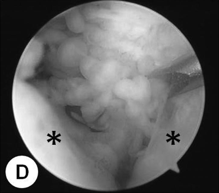 PFC: posterior articular facet of calcaneus, L: lateral malleolus, T: talus. Fig. 5.