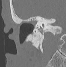 과거의수술로공동이형성된경우가운데유난히피질골편이부족하였던 7예에서는인공합성물질인 HA(Mimix,