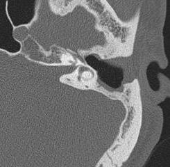 bone CT images (group Ⅰ).