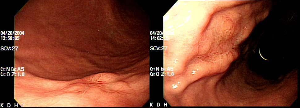 Tuberculosis and Respiratory Diseases Vol. 61. No.2, Aug. 2006 Figure 3. Gastrofibroscopy shows 2.0 and 1.