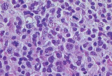 474 한재준 고영혜 조은윤외 3 인 A B C D Fig. 2. Nodal marginal zone B-cell lymphoma of mucosa-associated lymphoid tissue type.