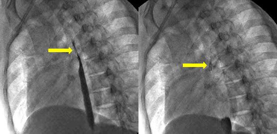 - 안은영외 5 인. 식도 - 종격동누공이동반된 NTM 감염 - Figure 5. () Esophagography revealed slit-like extraluminal contrast leakage anterior to the mid-esophagus (arrows).