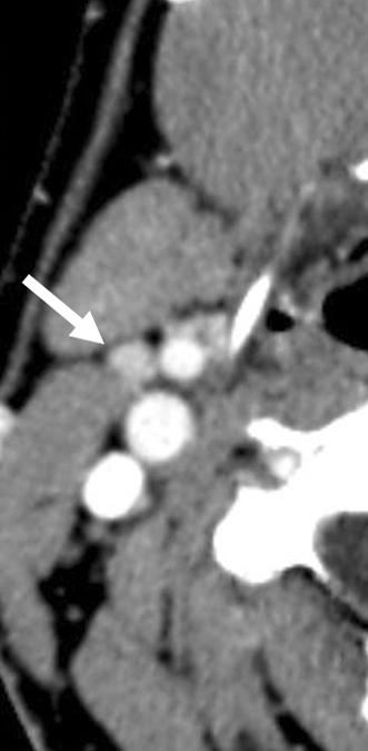 (A) US image shows a hypoechoic indeterminate lymph node with loss of normal hilar echo (arrow) in the right central neck.