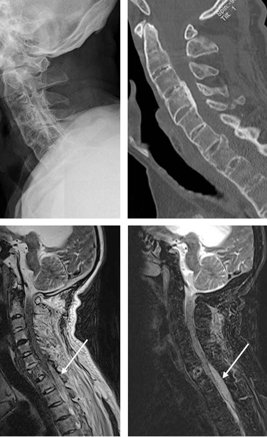 Journal of Korean Society of Spine Surgery Traumatic Epidural Hematoma with Ankylosing Spondylitis Patient A B A Fig. 2. Postoperative radiologic findings.
