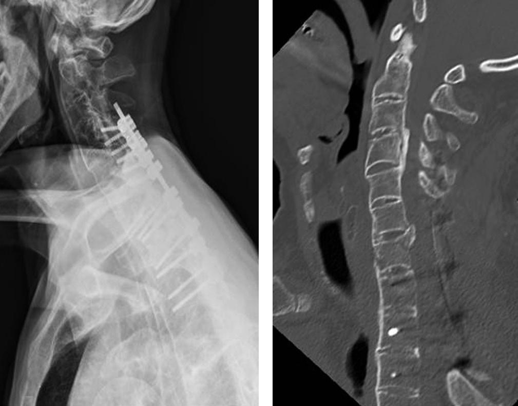 Initial radiologic findings taken 2 hours after the trauma. (A) A lateral X-ray shows the ankylosed cervical spine. (B) Computed tomography shows fracture of the C7 body.