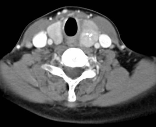 - MiJa Kang, et al. autonomously functioning thyroid nodule combined with subacute thyroiditis - 증 례 Figure 1. Computed tomography (CT) scans of the neck.