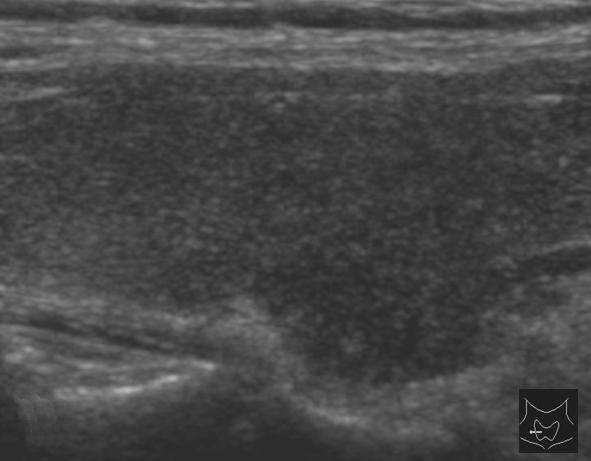 () Two months later, the Ill-defined hypoechoic lesion in the right thyroid lobe is nearly normalized. Figure 4.