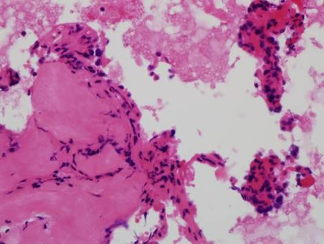 The cell block section of the same nodule shows follicles of bland follicular cells, stromal fibrosis (), and multinucleated giant cells (C) (H&E stain;, original magnification, 400). 였다.