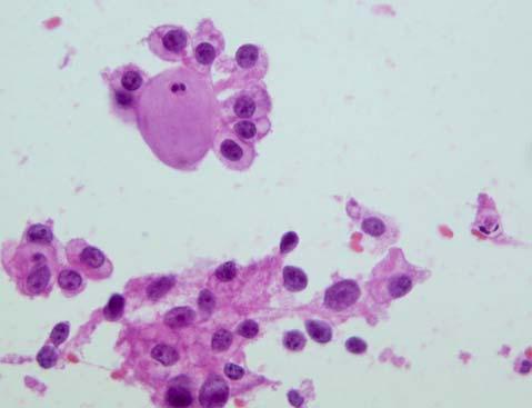 sheets 2 Tumor cells Bare nuclei 5 Cytoplasmic eosinophilic inclusion 5 Cytoplasmic vacuole 5 Intranuclear inclusion 4 Phagocytosis of lymphocytes 4 Raspberry body 4 Fig. 1. Scrape cytology findings.