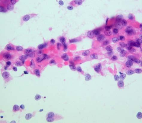 There are hyaline globules in cytoplasm and intercellular spaces (arrows). (H-E) Fig. 5. High power view of scrape cytology.