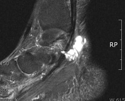 (A) Figure 1. (A) Ankle MRI of a 44 year-old female shows multilocualr cyst adjacent to tibial nerve.