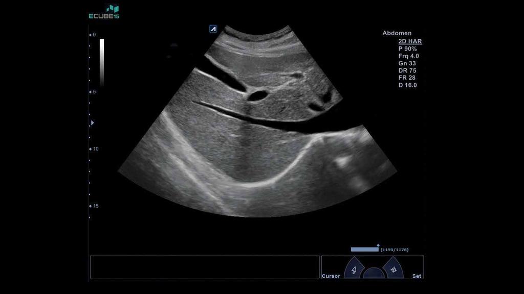 Thyroid cyst using extreme fine-pitched transducer