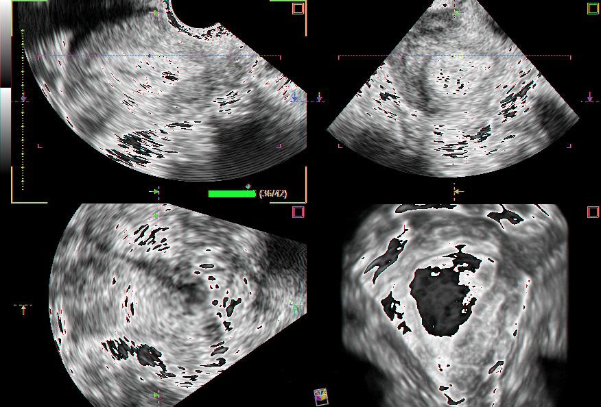color Doppler 빠른 수리기간 Sequential images of Lateral