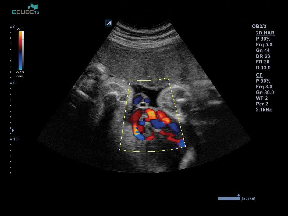 Multi-planar Rendering view demonstrating an endometrial