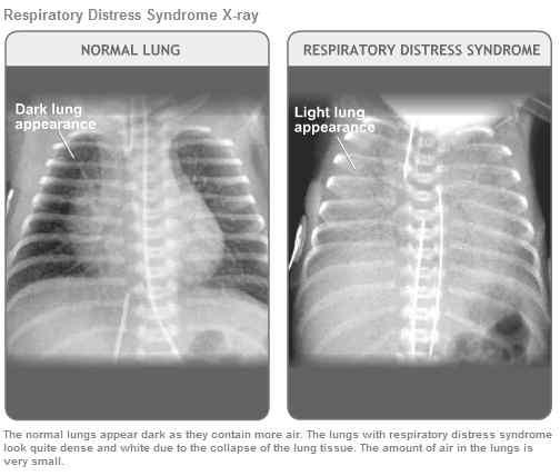 2. 호흡곤란증후군 (RDS) (5) 3. 태변흡인증후군 (MAS) (1) u Mecoium aspiratio sydrome 저산소성스트레스의결과로자궁내에서태변이유출되는것.