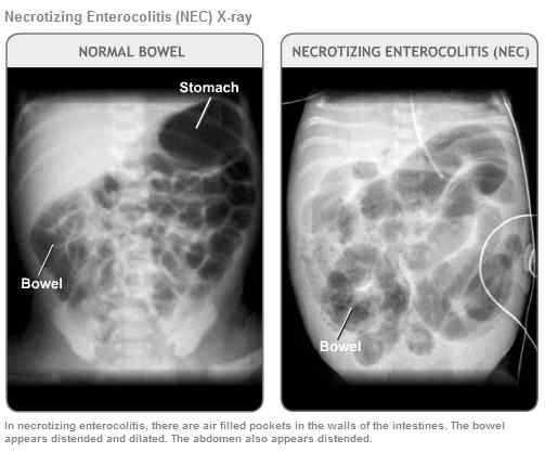 Eterocolitis, NEC) (3) 2) 임상증상