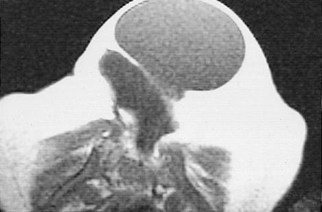 show a lowlying tethered spinal cord and two cystic compartmentsmyelocystocele and