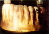 partial denture with the distal connection and mesial rest(loaded