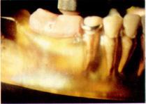 되게되는데, 치근막과치조점막의탄성차이로인 해유리단국소의치하에서발생하는응력의분포 는다양하며유리단국소의치설계의변화에따른 (9, 11, 13, 25, 31, 40, 41, 43, 47,