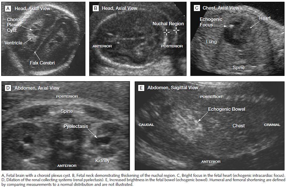 Fig.3 Fetal Ultrasonographic Markers for Risk of Down syndrome A, Fetal brain with a choroid plexus cyst. B, Fetal neck demonstrating thickening of the nuchal region.