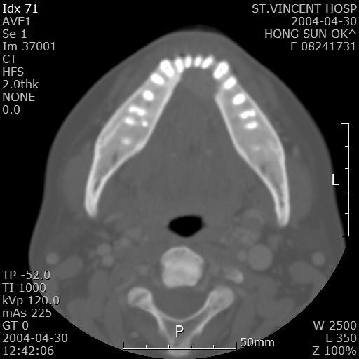 Panoramic view showing a welldefined radiolucent lesion in the anterior mandible (arrow).