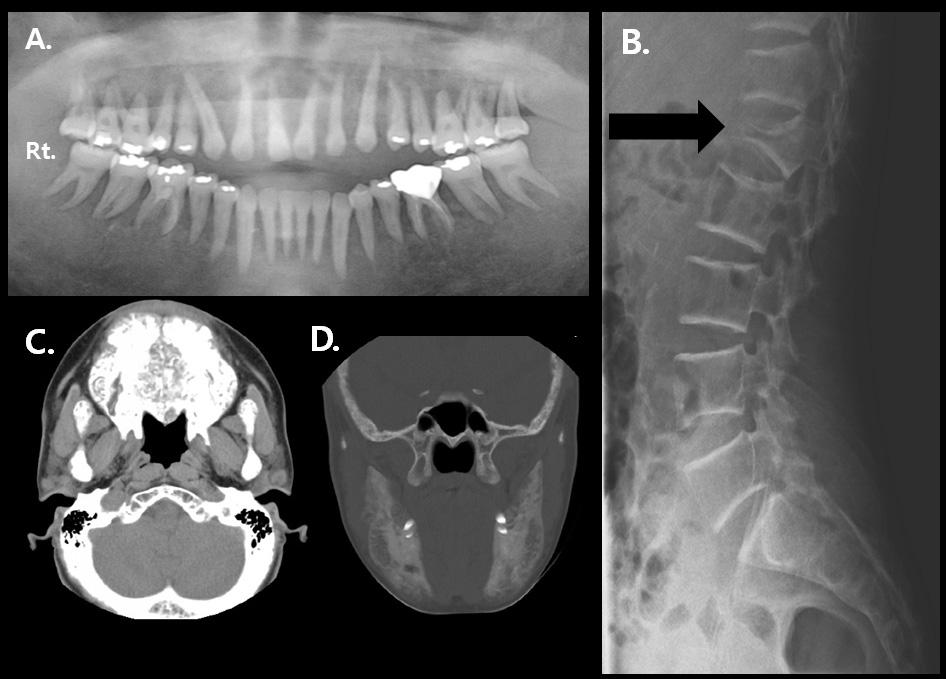 Wonjin Kim, et al:seven Year-follow-up of a Brown Tumor in the Maxilla Associated with Secondary Hyperparathyroidism in End-stage Renal Failure A B C D Fig. 1. Initial radiologic findings.