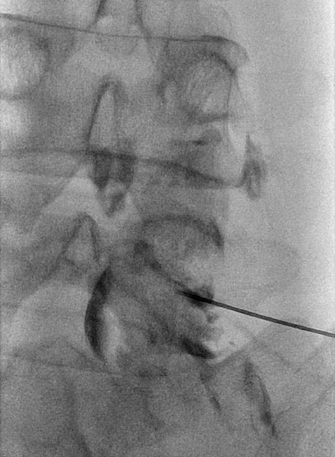 후관절활액낭종의위치는요추 4~5번관절이가장흔하 A B C D E Fig. 1. A 63-year-old female with synovial cyst presenting radiating pain of right lower extremity. A. T2-weighted axial MR image shows a 6.