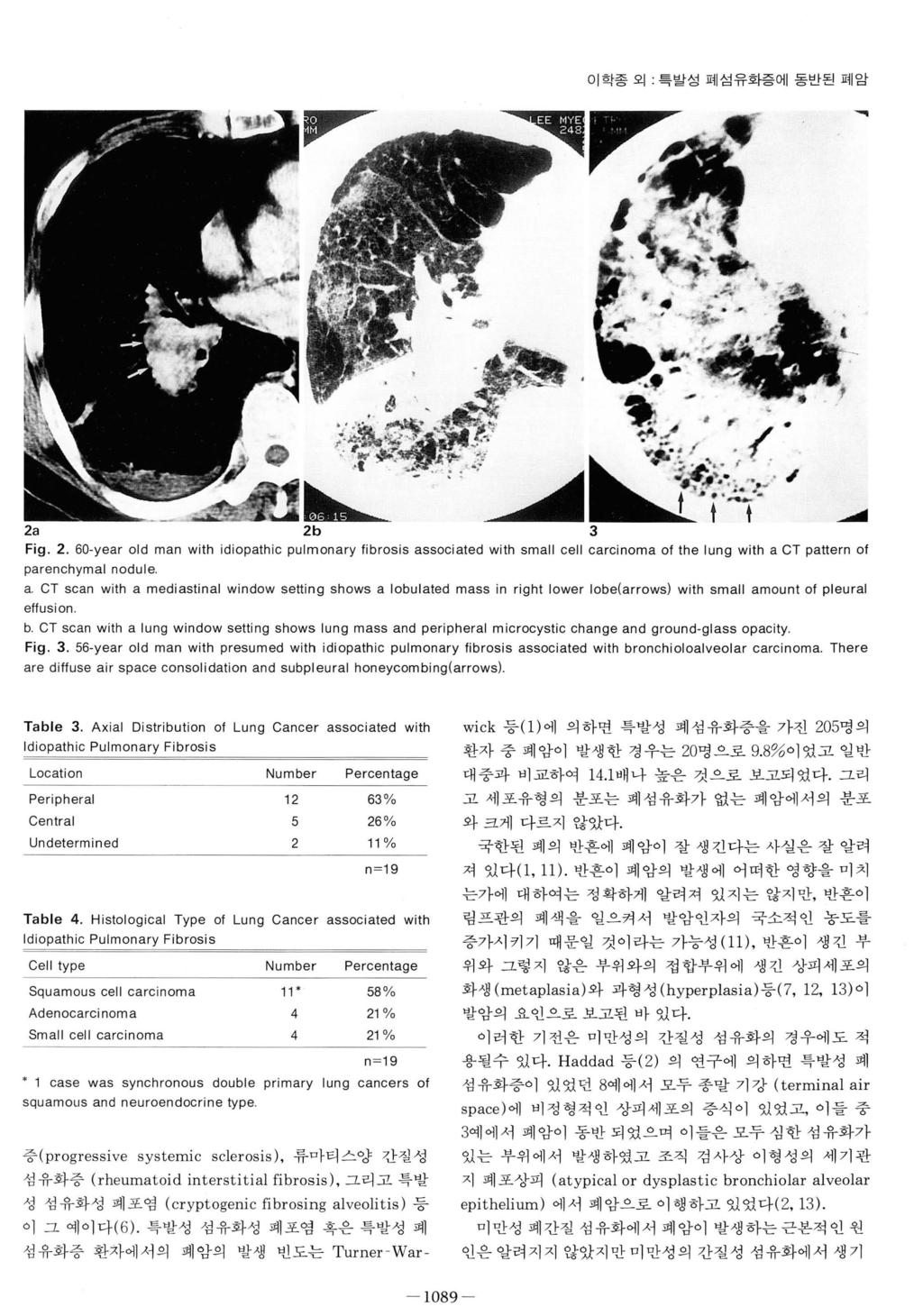 1089 - 이학종외 특발성폐섬유화증에동반된폐암 활짧 ~ 鳳 i - : : ii 순..-... 2a 2b 3 Fig. 2. 60-year old man with idiopathic pulmonary librosis associated with small cell carcinoma 01 the lung with a CT pattern 01 parenchymal nodule a.