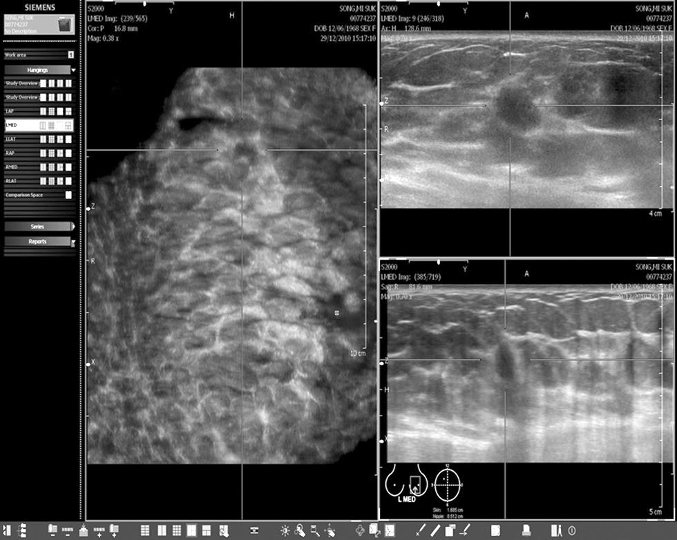 Multiplanar reconstruction of the volume data displayed on the automated breast volume scanner. Fig. 3.
