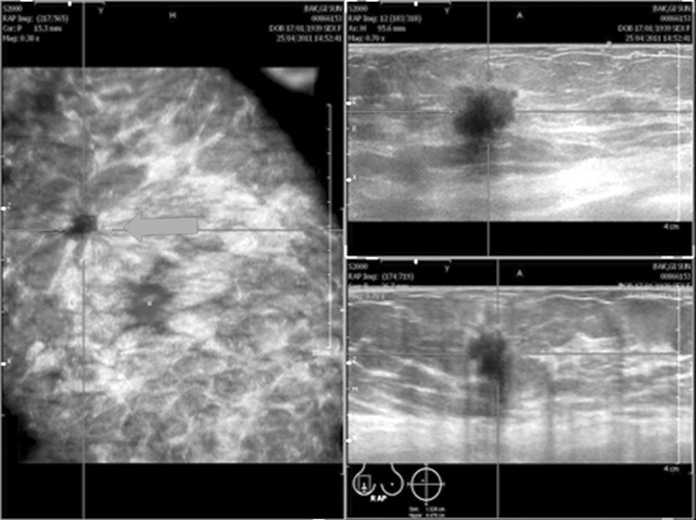 Sang Yull Kang, et al.: Clinical Significance of Automated Breast Ultrasound Fig. 4. Retraction phenomenon in standard automated breast volume scanning images.