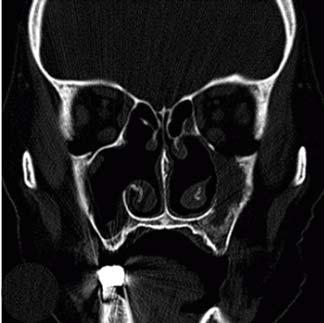 Preoperative axial () and coronal () images show