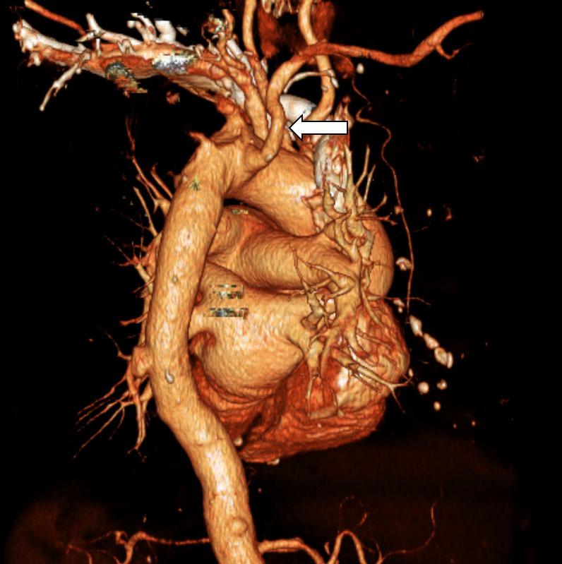 (C) Three-dimensional reconstructed CT images of the aberrant right subclavian artery.