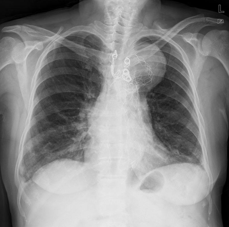 (A) Chest X-ray, performed immediately after thoracic endovascular aneurysm repair (TEVAR).