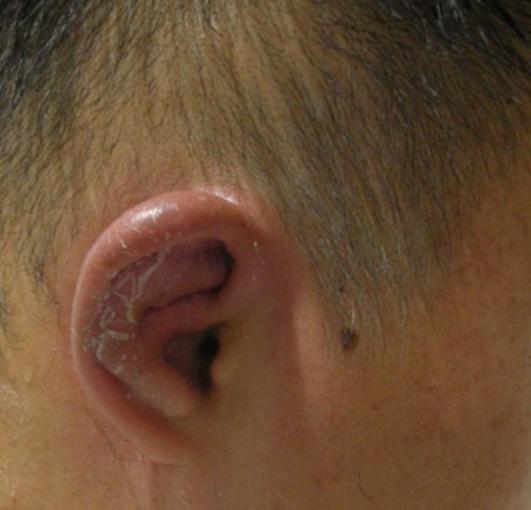 - 대한내과학회지 : 제 76 권제 5 호통권제 585 호 2009 - Figure 2. Both ears show painful erythematous swelling. Figure 3.
