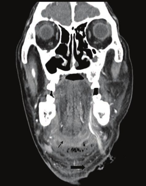 루드비히앙기나부검증례 나주영외 129 Fig. 3. Massive inflammation and necrosis, which do not involve the salivary glands, are noted (H&E, 50). Fig. 2.