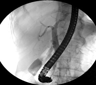 (B) Retrograde cholangiography shows no evidence of biliary tree abnormality or leakage of contrast media. (C) Contrast media injected into pleural cavity via Pigtail cathether.