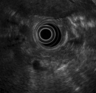 전성완외 6 인 : 두종류의항체를보유한자가면역성저혈당 1 예 A B C Fig. 1. Pancreatic imaging studies showed no evidence of mass lesion. A. Endoscopic ultrasonography.