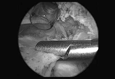 () rthroscopic view of a right shoulder from the posterior portal showing a retracted margin of the torn rotator cuff (white arrow) medial to the glenoid () This