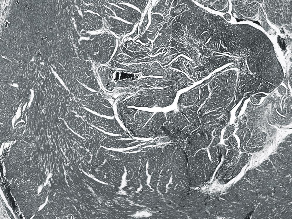 대흉외지 2005;38:468-475 Fig. 4. Histologic examination shows massive fibrosis and calcification in the endocardium.