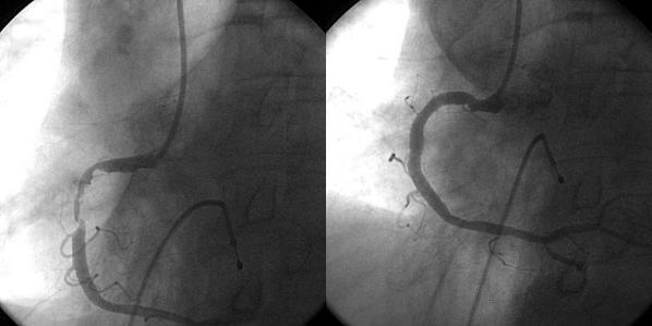 - Jae Young Park, et al. Temporary pacemaker-induced ventricular tachycardia - A B Figure 2. Coronary angiography (CAG). (A) Initial CAG showed 90% occlusion of the proximal right coronary artery.