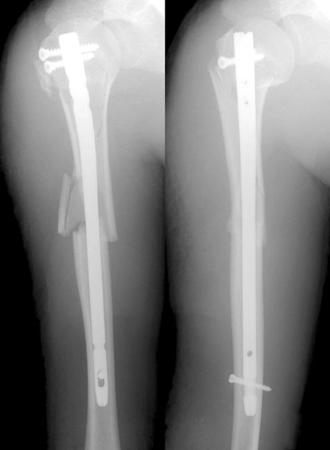 (C) Radiograph at 6 months after the surgery show complete bony union. ig. 3.
