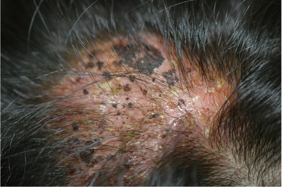 대한의진균학회지 제16권 제4호 2011 A Fig. 1. Localized painful multiple erythematous pustules with crusted plaques on scalp. 여 결국 수술적으로 흉터형성탈모를 교정한 백선 종창 1예를 경험하고 이를 문헌고찰과 함께 보고 한다.