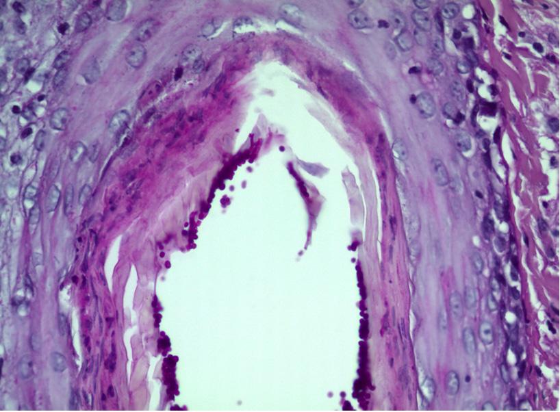 발열이나 후방경부림프절병 염증세포와 호산구 침윤이 관찰되었으며 모낭염 (posterior cervical lymphadenopathy)은 관찰되지 않 과 모낭주위염 소견을 보였다. PAS 염색상 모낭 았으며 그 외 다른 동반 증상은 없었다. 수 개월 주변에 포자가 관찰되었다 (Fig. 2A, Fig. 2B).